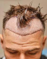 What is the average hair transplant cost