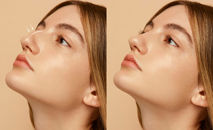 Nasal reshaping surgery