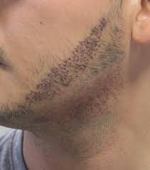 Precise mustache transplant